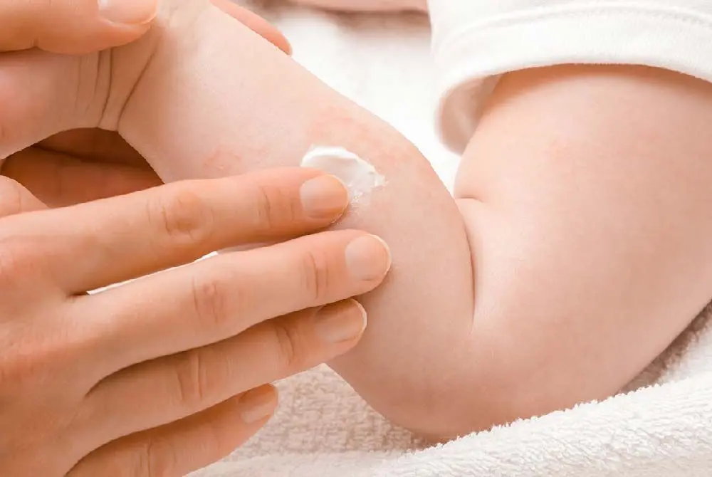 Common Skin Conditions in Newborns